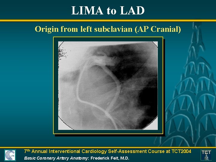 LIMA to LAD Origin from left subclavian (AP Cranial) 7 th Annual Interventional Cardiology