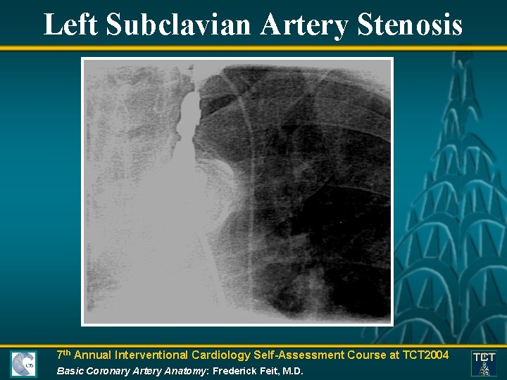 Left Subclavian Artery Stenosis 7 th Annual Interventional Cardiology Self-Assessment Course at TCT 2004