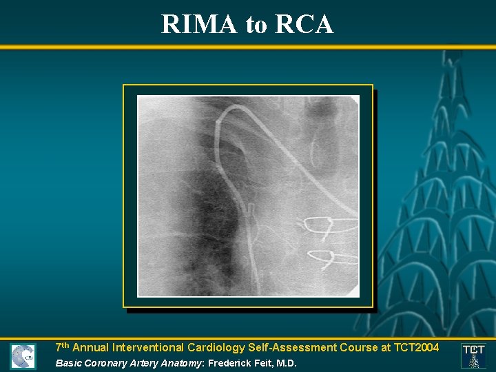 RIMA to RCA 7 th Annual Interventional Cardiology Self-Assessment Course at TCT 2004 Basic