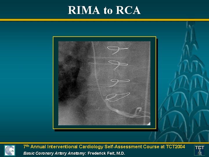 RIMA to RCA 7 th Annual Interventional Cardiology Self-Assessment Course at TCT 2004 Basic