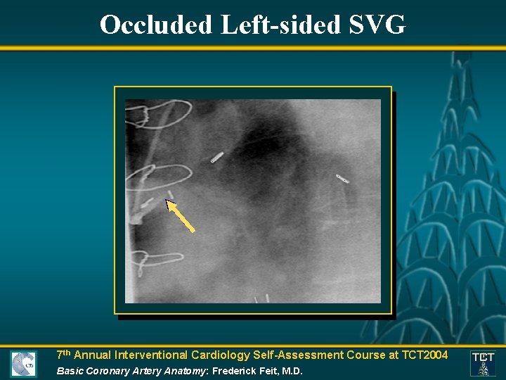 Occluded Left-sided SVG 7 th Annual Interventional Cardiology Self-Assessment Course at TCT 2004 Basic