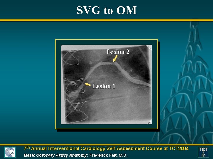 SVG to OM Lesion 2 Lesion 1 7 th Annual Interventional Cardiology Self-Assessment Course