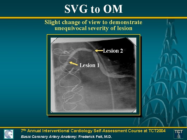 SVG to OM Slight change of view to demonstrate unequivocal severity of lesion Lesion