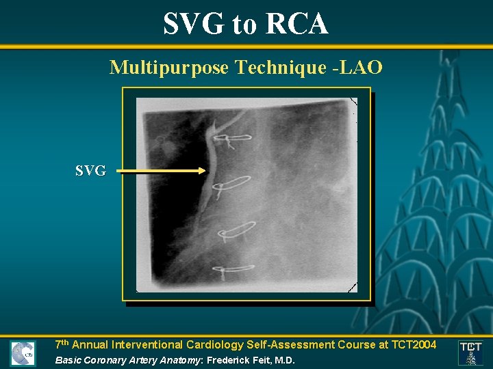 SVG to RCA Multipurpose Technique -LAO SVG 7 th Annual Interventional Cardiology Self-Assessment Course