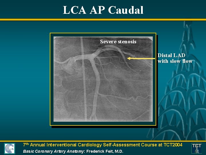 LCA AP Caudal Severe stenosis Distal LAD with slow flow 7 th Annual Interventional