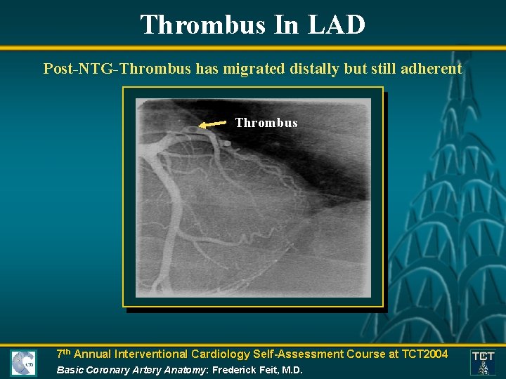 Thrombus In LAD Post-NTG-Thrombus has migrated distally but still adherent Thrombus 7 th Annual