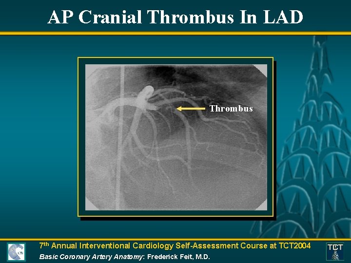 AP Cranial Thrombus In LAD Thrombus 7 th Annual Interventional Cardiology Self-Assessment Course at