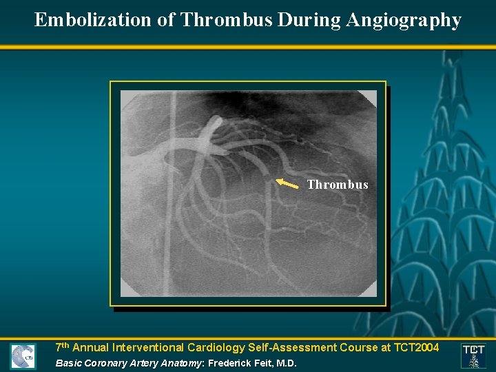 Embolization of Thrombus During Angiography Thrombus 7 th Annual Interventional Cardiology Self-Assessment Course at