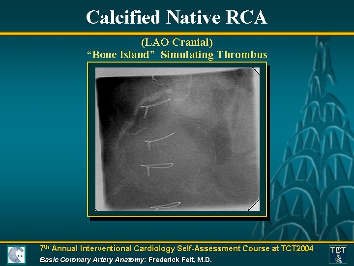 Calcified Native RCA (LAO Cranial) “Bone Island” Simulating Thrombus 7 th Annual Interventional Cardiology