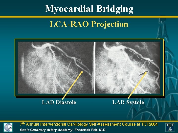 Myocardial Bridging LCA-RAO Projection LAD Diastole LAD Systole 7 th Annual Interventional Cardiology Self-Assessment