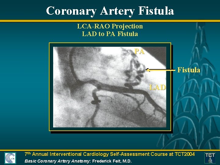 Coronary Artery Fistula LCA-RAO Projection LAD to PA Fistula LAD 7 th Annual Interventional