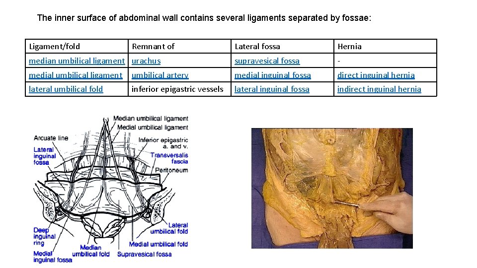 The inner surface of abdominal wall contains several ligaments separated by fossae: Ligament/fold Remnant