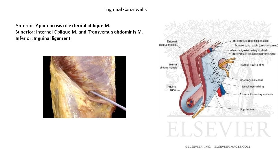 Inguinal Canal walls Anterior: Aponeurosis of external oblique M. Superior: Internal Oblique M. and