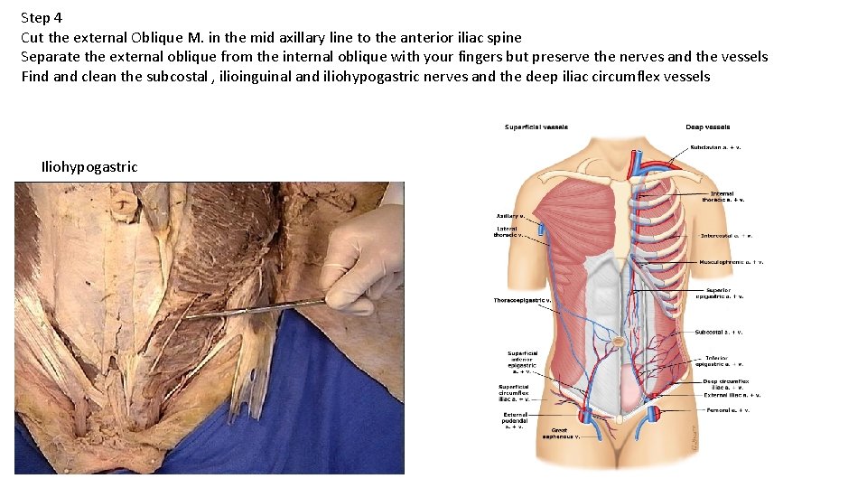 Step 4 Cut the external Oblique M. in the mid axillary line to the