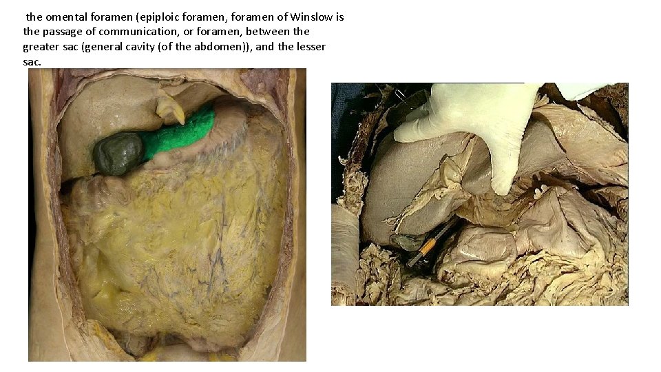 the omental foramen (epiploic foramen, foramen of Winslow is the passage of communication, or