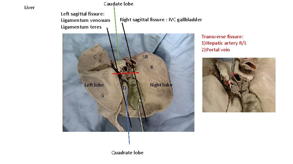 Liver Caudate lobe Left sagittal fissure: Ligamentum venosum Ligamentum teres Right sagittal fissure :