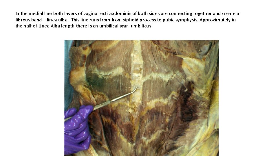 In the medial line both layers of vagina recti abdominis of both sides are