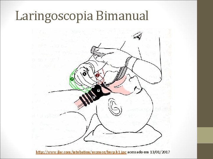 Laringoscopia Bimanual http: //www. jlar. com/intubation/urgence/burp. h 1. jpg acessado em 13/01/2017 