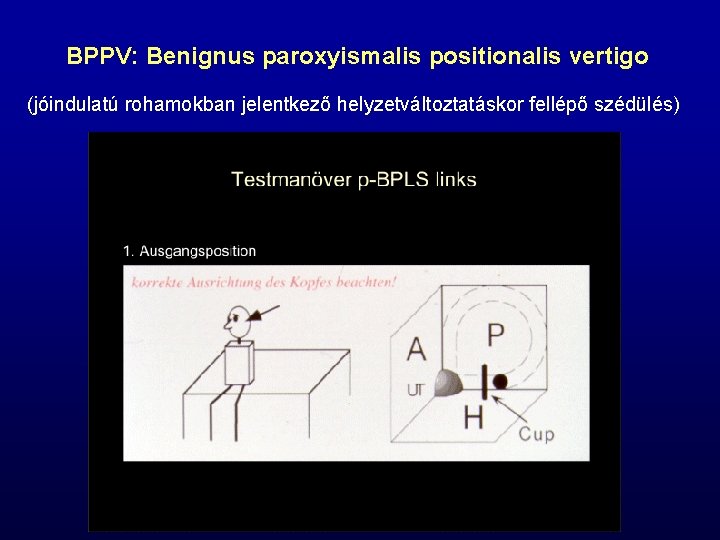 BPPV: Benignus paroxyismalis positionalis vertigo (jóindulatú rohamokban jelentkező helyzetváltoztatáskor fellépő szédülés) 