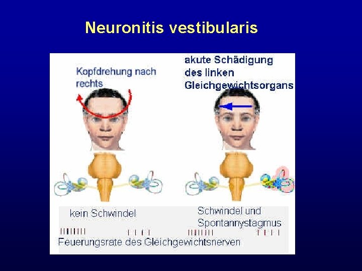 Neuronitis vestibularis 