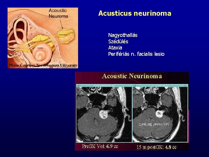 Acusticus neurinoma Nagyothallás Szédülés Ataxia Perifériás n. facialis lesio 