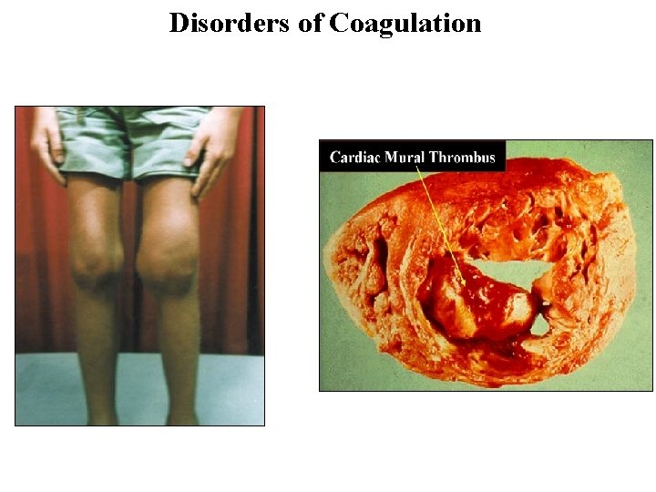 Disorders of Coagulation Hypocoagulation: Hypercoagulation: Hemophilia A Cardiovascular diseases: Hemophilia B Arthroscleroses Others Emboli