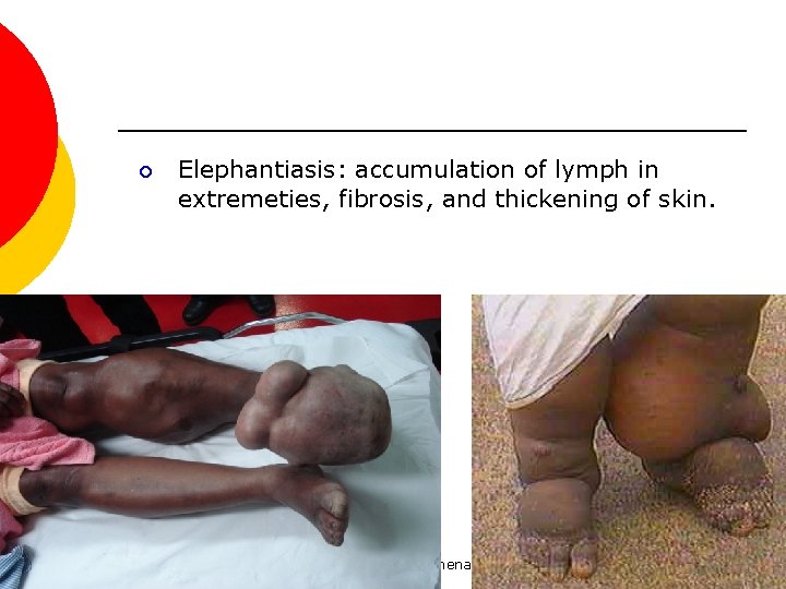 ¡ Elephantiasis: accumulation of lymph in extremeties, fibrosis, and thickening of skin. para-lab by