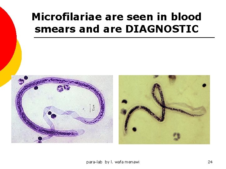 Microfilariae are seen in blood smears and are DIAGNOSTIC para-lab by l. wafa menawi