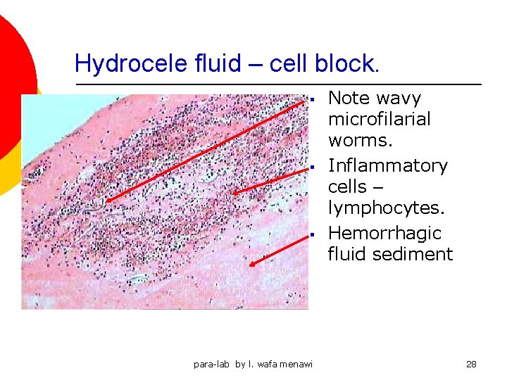 Hydrocele fluid – cell block. § § § para-lab by l. wafa menawi Note