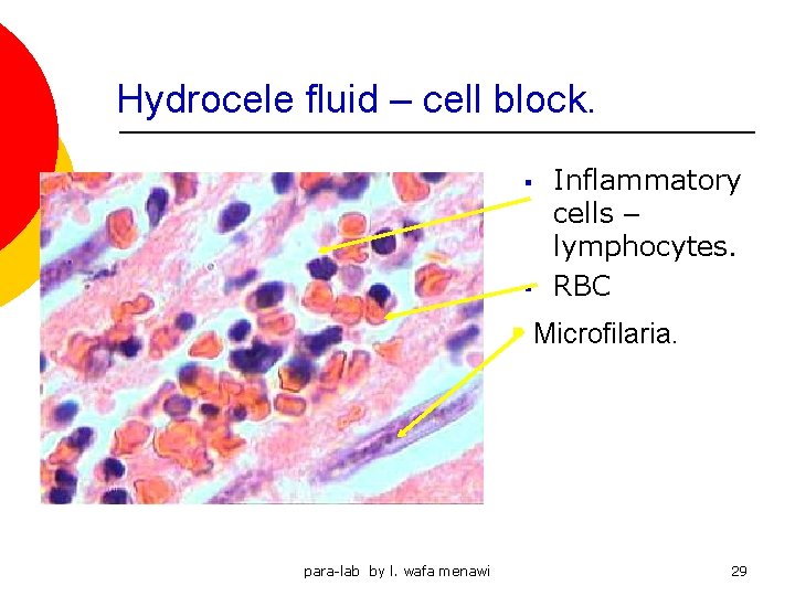 Hydrocele fluid – cell block. § § Inflammatory cells – lymphocytes. RBC § Microfilaria.