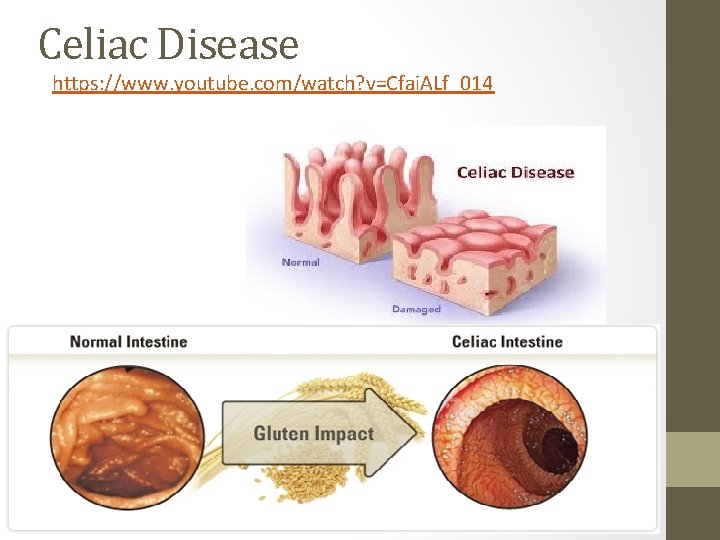 Celiac Disease https: //www. youtube. com/watch? v=Cfai. ALf_014 