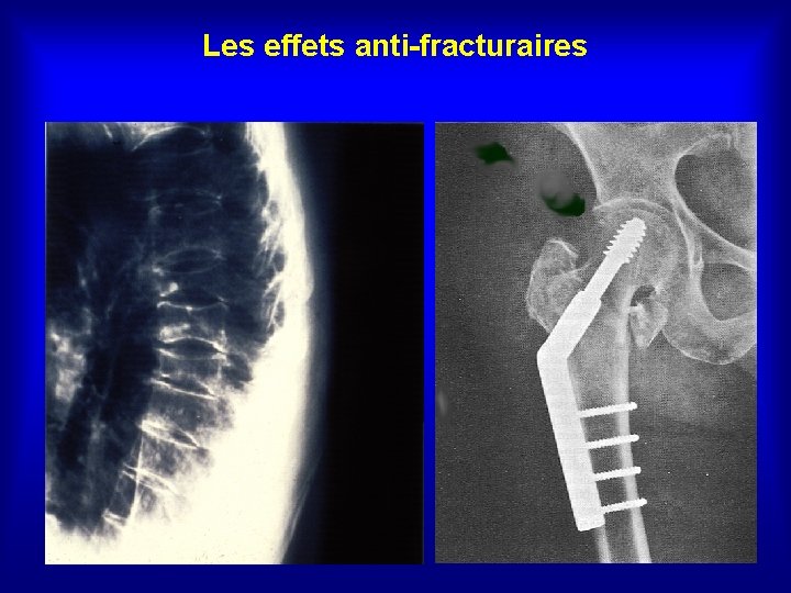 Les effets anti-fracturaires 
