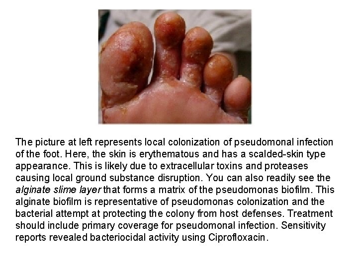 The picture at left represents local colonization of pseudomonal infection of the foot. Here,