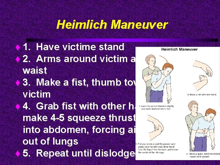 Heimlich Maneuver 1. Have victime stand 2. Arms around victim at waist 3. Make