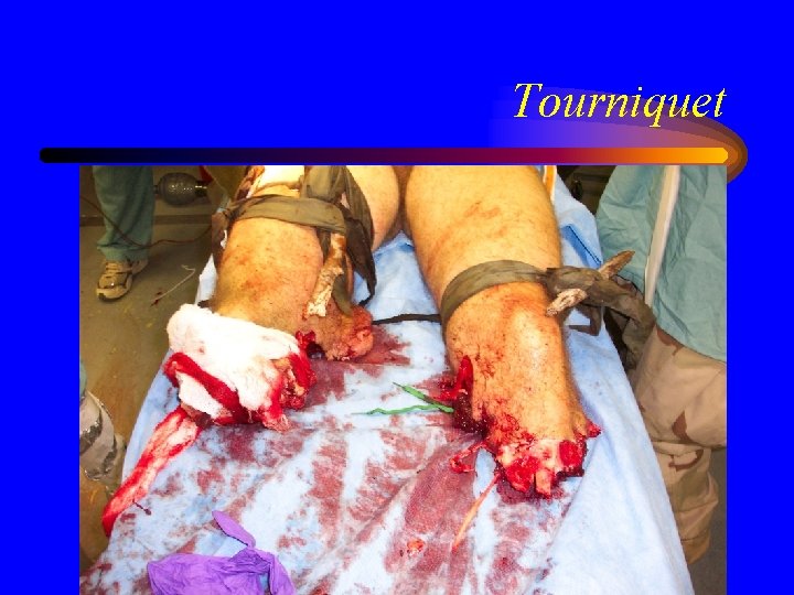 Tourniquet 