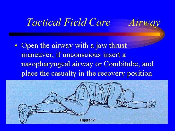 Tactical Field Care Airway • Open the airway with a jaw thrust maneuver, if