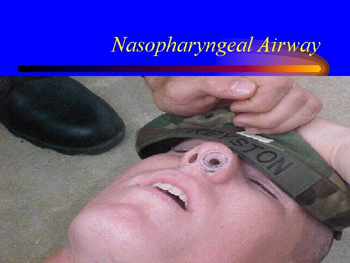 Nasopharyngeal Airway 