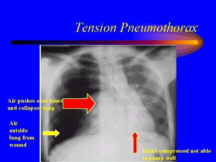 Tension Pneumothorax Air pushes over heart and collapses lung Air outside lung from wound
