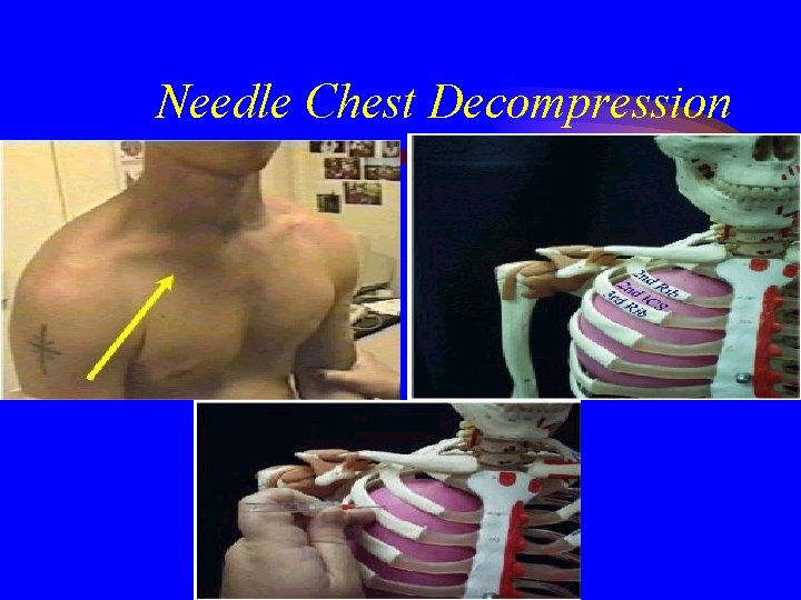 Needle Chest Decompression 