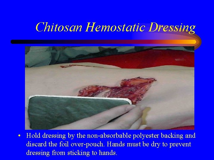 Chitosan Hemostatic Dressing • Hold dressing by the non-absorbable polyester backing and discard the