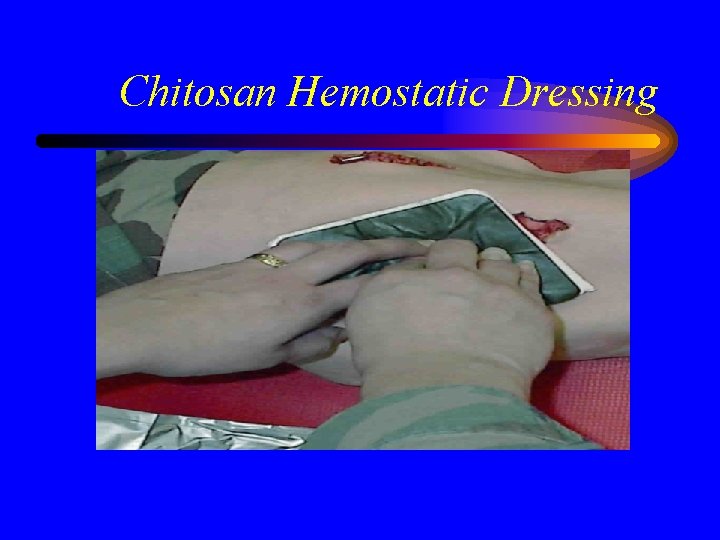 Chitosan Hemostatic Dressing 