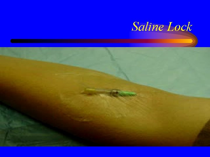Saline Lock 
