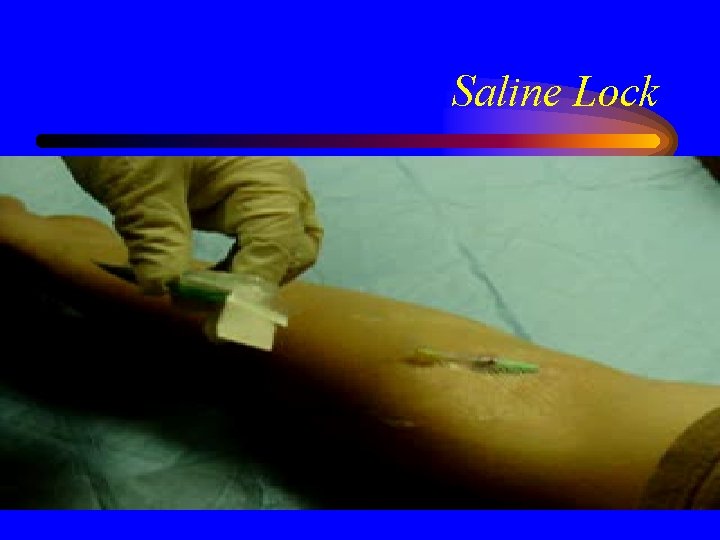 Saline Lock 