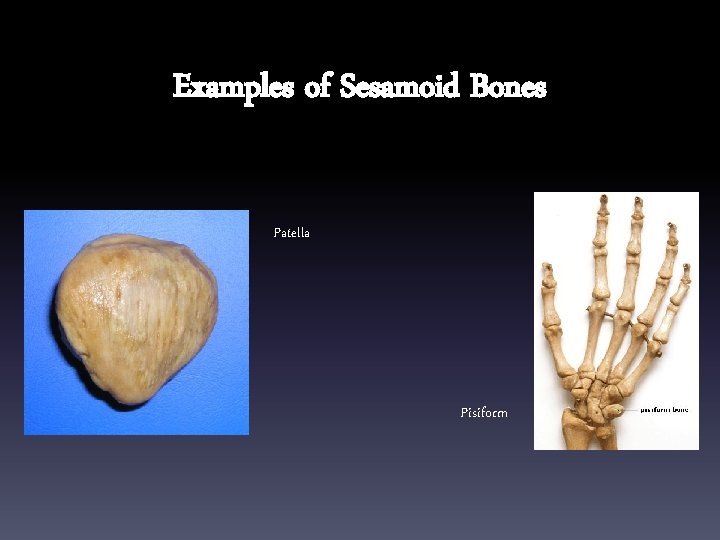 Examples of Sesamoid Bones Patella Pisiform 