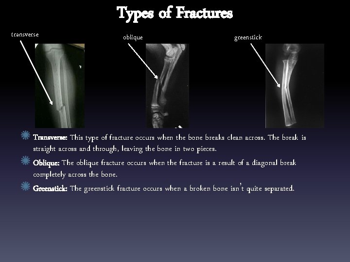 transverse Types of Fractures oblique greenstick Transverse: This type of fracture occurs when the