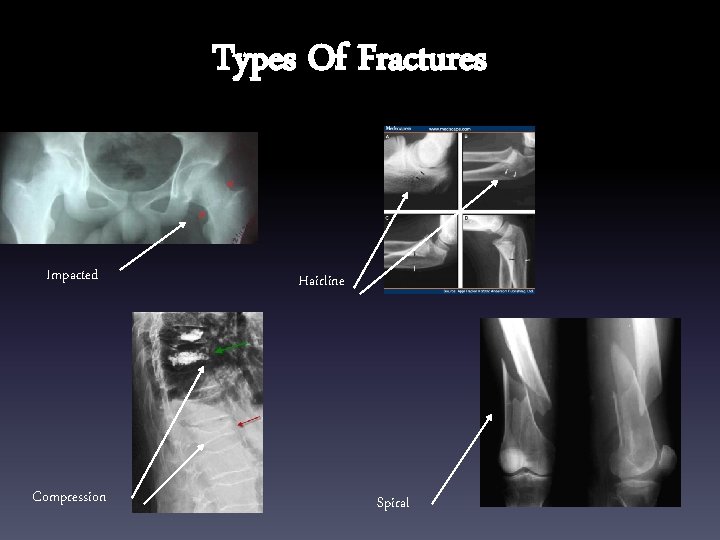 Types Of Fractures Impacted Compression Hairline Spiral 