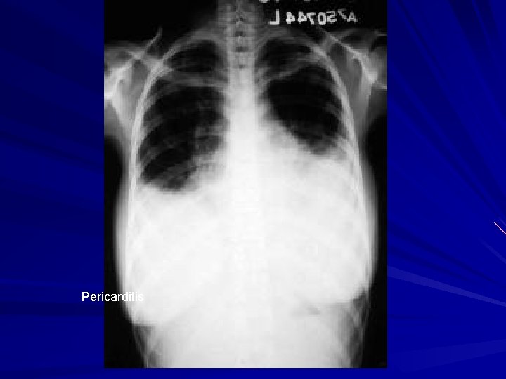 Pericarditis 