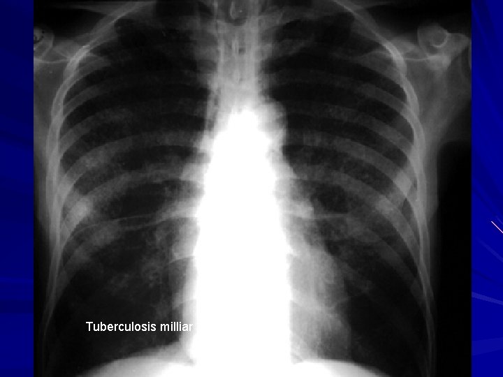 Tuberculosis milliar 