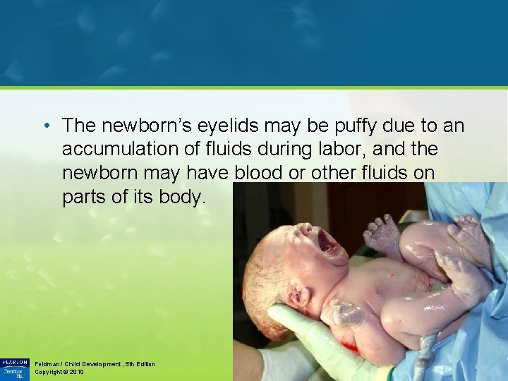  • The newborn’s eyelids may be puffy due to an accumulation of fluids