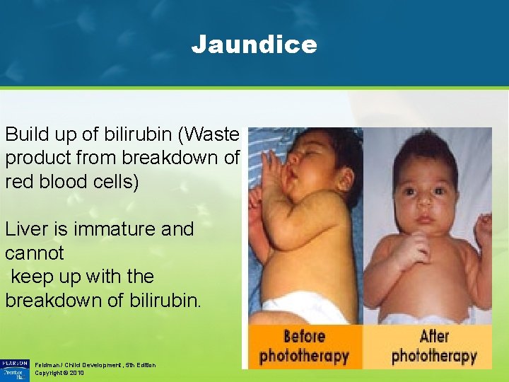 Jaundice Build up of bilirubin (Waste product from breakdown of red blood cells) Liver